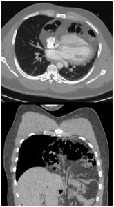 Figure 2. Transverse (top) and sagittal (bottom) computed tomography (CT) images demonstrating posterior displacement of the anterior heart by transdiaphragmatic herniated bowel.