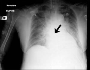 Figure 1. Chest radiograph shows central venous catheter overlying left internal jugular vein traversing the mediastinum.