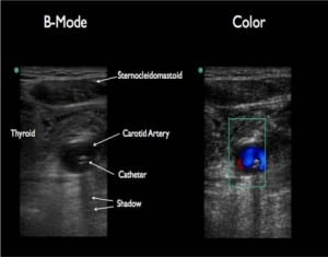Figure 2. Ultrasound visualization of catheter within the lumen of the left carotid artery with conformation using color flow dropper.