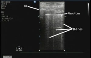 Figure 1. Sonographic B-lines identified with a linear transducer