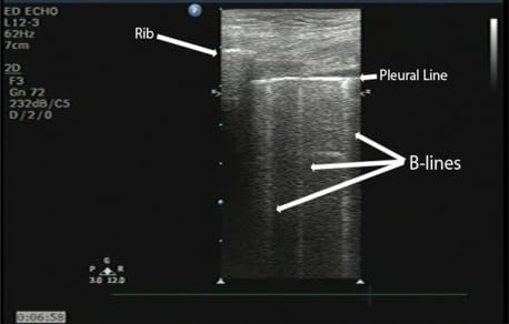 Identification of Sonographic B-lines with Linear Transducer Predicts Elevated B-Type Natriuretic Peptide Level