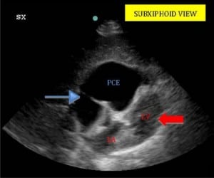 Figure. Bedside echocardiogram – subxiphoid view (SX) of heart. Loculated anterior pericardial effusion (PCE) is evident (thin blue arrow) showing obliteration of right heart. Left ventricle (LV) and atrium (LA) is also visible (red arrow).