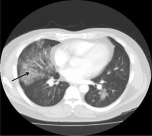 Figure 1. Computed tomography of the chest showing consolidation of right lower lobe with arrow showing pulgged bronchioles.