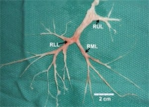 Figure 2. Bronchial Cast showing complete casting of right upper lobe (RUL), right middle lobe (RML) and right lower lobe (RLL).