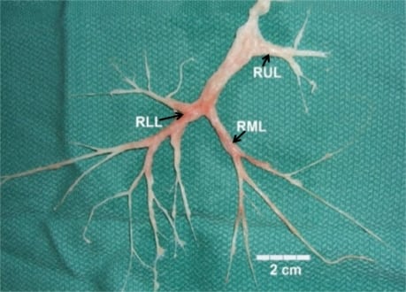 Plastic Bronchitis