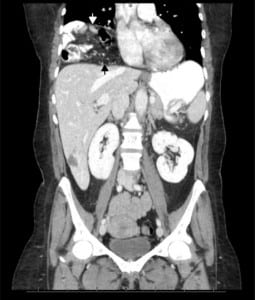 Figure 2. Coronal computed tomography image showing multiple bowel loops within the right thoracic cavity (white arrow) consistent with a Morgagni hernia. The diaphragm can be identified below the hernia contents (black arrow).