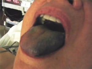 Figure 1. Discoloration of the patient’s tongue