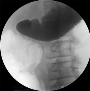 Figure 1. Gastrograffin meal showing complete gastric outlet obstruction.