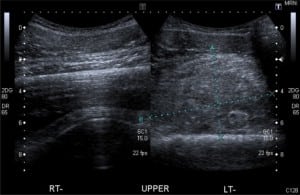 Figure. Ultrasonogram suggesting a hematoma between the quadriceps muscle and anterior femoral cortex.