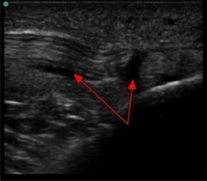 Figure 1. Dark, anechoic areas within the tendon and surrounding the tendon bundle represent fluid from inflammation (red arrows)