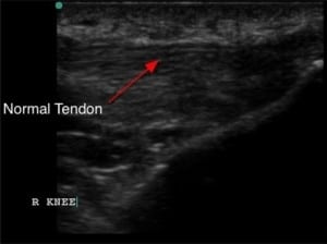 Figure 2. Normal patellar tendon appears as a tightly packed, fibrillar tissue bundle represented by bright, hyperechoic parallel lines (red arrow) which attaches to the tibial tuberosity
