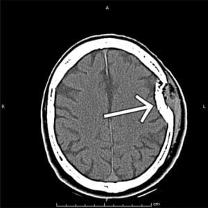 Figure 1. Computed tomography of a left-sided depressed skull fracture and associated subdural hematoma over the temporal region of the cortex resulting in persistent expressive aphasia.