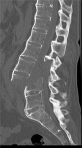 Figure. Sagittal computed tomography of the lumbar spine without contrast demonstrating fracture and severe anterior displacement of the lumbar spine at the lumbar four (L4) level. Osteoproliferation and syndesmophyte formation are seen consistent with ankylosing spondylitits