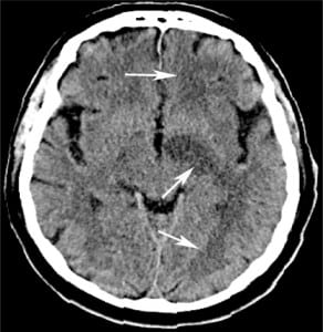 Figure 1. Left middle cerebral artery (MCA) infarction. Axial nonenhanced computer tomography demonstrates hypoattenuating foci throughout the left sided white matter (arrows) and sulcal effacement in the left MCA territory, consistent with infarction.