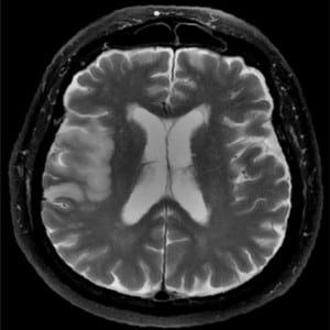 Figure 10. Right middle cerebral artery infarction. Fast spin echo T2-weighted fat suppressed image demonstrates increased signal intensity and effacement of the right temporal lobe, consistent with sub-acute infarct.