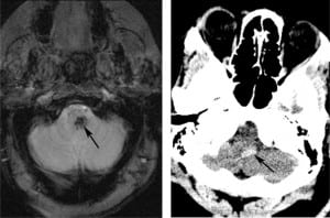 Figure 11. Hemorrhagic brainstem infarct. (A) Gradient echo axial magnetic resonance image depicts a focus of hypointensity due to paramagnetic effect of the hemosiderin, otherwise known as “blooming.” (B) Axial computed tomography through the brainstem demonstrates a corresponding hyperattenuating focus of hemorrhage (arrow) in the brainstem.