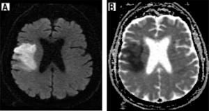 Figure 12. Right middle cerebral artery infarction. (A and B) Restricted water diffusion in the region of infarct results in an increased signal intensity on diffusion-weighted imaging (A) and decreased signal on apparent diffusion coefficient imaging (B).