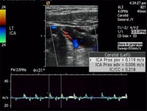 Figure 14. Acute high-grade internal carotid artery (ICA) occlusion. Longitudinal color Doppler image through the internal carotid artery demonstrates a “string” sign, with very minimal flow through the ICA.