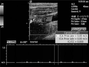 Figure 15. Acute complete internal carotid artery occlusion. Longitudinal sonogram of the left internal carotid artery demonstrates complete flow void, with no perceptible waveforms.