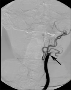 Figure 16. Internal carotid artery occlusion. Frontal projection from left cerebral angiogram delineates complete occlusion of the left internal carotid artery to the level of the common carotid artery (arrow). Note the normal opacification of the external carotid artery branches.