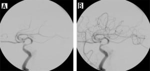 Figure 17. Left middle cerebral artery (MCA) recanalization. (A) Initial lateral image from cerebral angiogram demonstrates a paucity of vessels in the MCA distribution. (B) Repeat lateral angiogram after intra-arterial lysis demonstrates recanalization of flow and normalized perfusion.