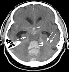 Figure 2. Massive subarachnoid and intraventricular hemorrhage. Axial nonenhanced computer tomography demonstrates a large “bright” or hyper attenuating dense subarachnoid hemorrhage throughout the perimesencephalic cistern (arrow) and along the tentorium (double arrows). The subarachnoid blood in the basilar cisterns has refluxed into the 4th (double arrowheads) and 3rd (arrowhead) ventricles. There is marked hydrocephalus. An arterio-venous malformation (please refer to Figure 8), was the etiology of this subarachnoid hemorrhage.