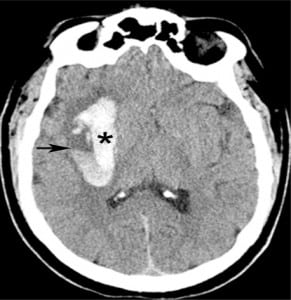 Figure 3. Hypertensive intraparenchymal hematoma. Nonenhanced computed tomography shows a large right basal ganglionic hematoma (*) containing a fluid/fluid level (arrow).