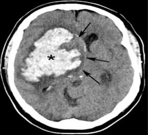 Figure 4. Hypertensive intraparenchymal hematoma with subfalcine herniation. Nonenhanced axial computed tomography demonstrates a large right basal ganglionic hypertensive bleed (*) with mass effect and midline shift or a subfalcine herniation to the left (arrows). The frontal horns are part of the lateral ventricles. The right frontal horn is compressed so severely that it is almost completely obliterated. Dilation of the left frontal horn is due to obstructive hydrocephalus – a consequence of compression of the third ventricle.