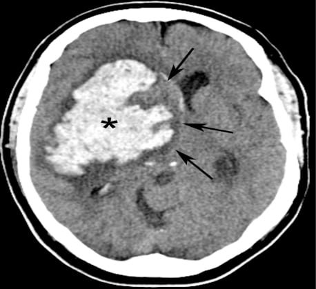 Imaging in Acute Stroke