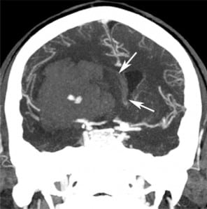Figure 5. Hypertensive intraparenchymal hematoma with subfalcine herniation. Coronal two-dimensional reconstruction from a computed tomography angiogram demonstrates transfalcine herniation (arrows) to the left due to large right sided intraparenchymal hemorrhage. Same patient as Figure 4