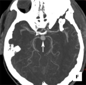 Figure 6. Basilar tip artery aneurysm. Computed tomography angiogram in the axial projection demonstrates a focal basilar tip artery aneurysm (arrow).