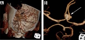 Figure 7. Anterior communicating artery (ACoA) aneurysm. (A) Cerebal computed tomography angiogram (CTA) in three-dimensional projection with skull surface overlay demonstrates an anterior communicating artery aneurysm. (B) Dedicated images from CTA of the Circle of Willis isolates the aneurysm (arrow).
