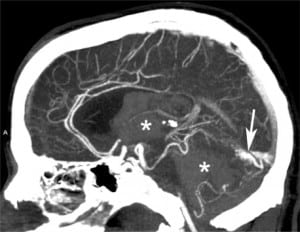 Figure 8. Subarachnoid and intraventricular hemorrhage due to vascular malformation. Sagital reformatted images from computed tomography angiogram demonstrates the enhancing vascular malformation (arrow), which was the etiology of the intraventricular hemorrhage (same patient in Figure 2).