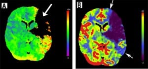 Figure 9. Left middle cerebral artery infarct. (A) Regional cerebral blood flow map from computed tomography perfusion shows a large perfusion defect in the left frontal and temporal lobes, evidenced by a lack of color display. (B) Regional cerebral blood volume map demonstrates a penumbra of decreased perfusion (indicated with arrows around blue areas) surrounding the defect (purple), indicating potentially reversible ischemia about the perfusion defect.