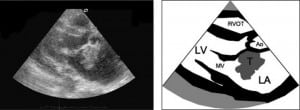 Figure 1. Left atrial tumor on the echocardiography (parasternal long axis view