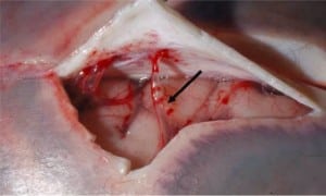 Figure 3. A bridging vein (arrow) at autopsy connecting the dura (reflected) and the brain surface.