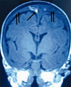 Figure 4. Magnetic resonance imaging of an infant showing massive bleeding from a torn bridging vein with active bleed near the superior sagital sinus (white area is acute blood leaking out, single arrow) and large subdural hematoma filling the subdural space (double arrows).