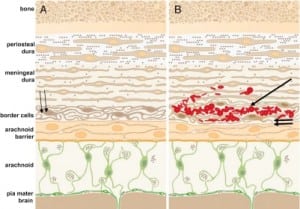 Figure 5a. Dural anatomy and early intradural collection of blood.