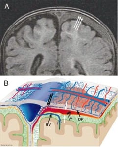 Figure 5c. Left subdural compartment hemorrhage.