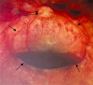 Figure 6a. Schisis cavity on the macula, also referred to a boat shaped retinal hemorrhage or macular schisis, of a child lying right side down with free blood in the cavity creating a red blood cell/serum interface. The edges of the schisis cavities (single arrows) form ridges that are called retinal folds. Optic disc at double arrows.