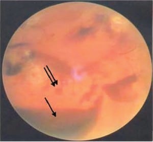 Figure 6b. Vitreous hemorrhage (single arrow) and a typical retinal hemorrhage (double arrows) on indirect opthalmoscopy unrelated to abuse.