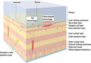 Figure 6d. Retinal microanatomy. Schisis cavities are in same layer as the flame shaped hemorrhages (under the ILM) but larger and centrally located (Figure 6a). Other types of retinal hemorrhage described in abuse cases are shown as well. With more widespread capillary damage, vitreous hemorrhage occurs (Figure 6b).