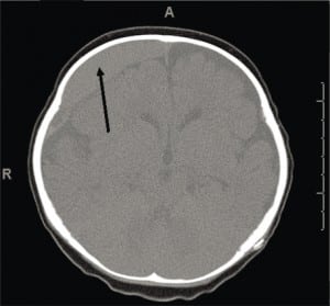 Figure 8a. Same four month old female in figure 7; Second computed tomography after admit. New acute subdural hematoma in right frontal area (arrow) that occurred in the hospital after an lumbar puncture without anesthesia.