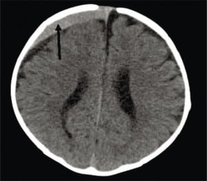 Figure 8b. Same four month old female as Figure 8a, three months later with acute subdural now a chronic subdural (arrow) attached to inner layer of dura (dural border cell layer), compressing the hygroma space and right ventricle.