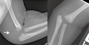 Figure 1. Anterior/posterior and lateral images of elbow demonstrate abnormal alignment with the black arrow pointing out the site of distal humeral physes and the white arrow pointing out the location of the posteriorly displaced cartilaginous humeral epiphysis.