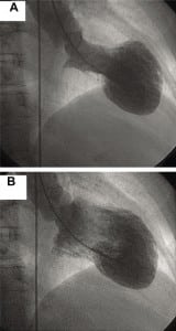 Figure 2. Left ventriculogram of patient seven in systole (A) and diastole (B) shows the classic apical ballooning and hypercontraction of the basal segments in Takotsubo Syndrome.