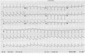 Figure 1. Initial electrocardiogram obtained on presentation showing inferior and lateral ST segment elevations.