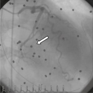 Figure 2. Left coronary angiogram (right anterior oblique cranial view), demonstrating an abrupt cutoff of the second obtuse marginal vessel secondary to a shotgun pellet.