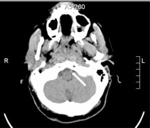 Figure 1. Initial head computed tomography. There is a high density signal in the distal left vertebral artery (solid arrow) secondary to possible thrombus versus slow flow.