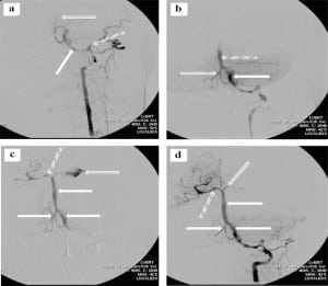 Figure 2. a. Initial angiogram. There is wall irregularity (solid arrow) and possible pseudoaneurysm (dashed arrow) in the distal cervical segment of the left vertebral artery. There is no opacification of the intra-dural segment of the left vertebral artery distal to the posterior inferior cerebellar artery (open arrow) secondary to possible dissection with thrombus. b. Follow up angiogram after mechanical thrombectomy. There is opacification of the left vertebral artery (solid arrow) and the distal basilar artery (dashed arrow). There is reflux opacification of the right vertebral artery (open arrow). c. Follow up angiogram after heparin administration. There is opacification of the bilateral vertebral and basilar arteries (solid arrows). There is opacification of the right posterior cerebral artery (dashed arrow). There is opacification of the left posterior cerebral artery with contrast extravasation (open arrow). d. Final post-thrombectomy angiogram. There is opacification of the bilateral vertebral and basilar arteries (solid arrows). There is opacification of the right posterior cerebral artery (dashed arrow). The left posterior cerebral artery is poorly opacified (open arrow). The contrast extravasation seen previously (Figure 2c) has been successfully treated after heparin reversal with protamine. Of note, the left vertebral artery appears to be the dominant vertebral artery in this patient; the right vertebral artery is considerably smaller than the left.